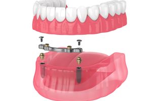 3D render of a implant-retained dentures procedure.