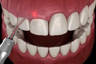 What is a gum lift?