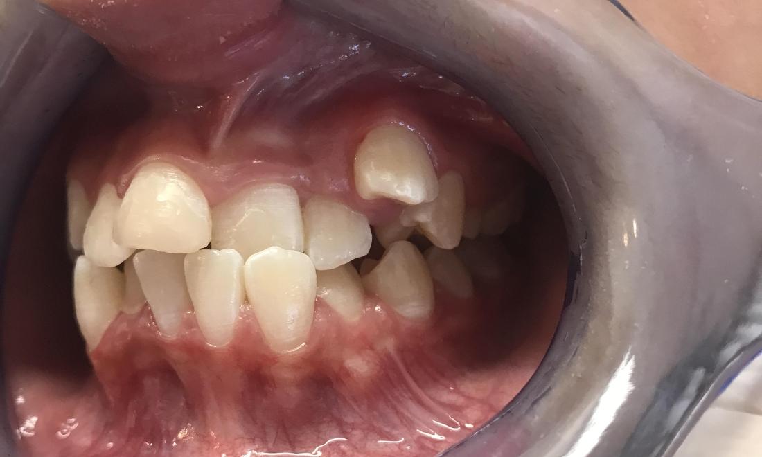 Braces and Invisalign - Before - Right Side