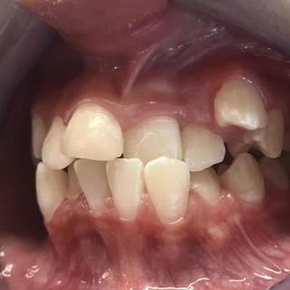 Braces and Invisalign - Before - Right Side