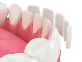 ceramic veneer