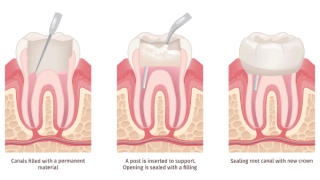 Stages of a root canal - from the filling of tooth to the instalment of the crown