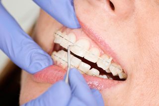 Clear Braces