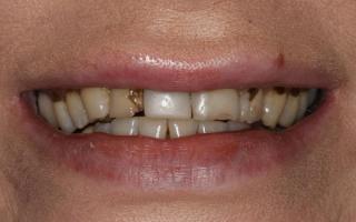 Dental Veneers transformation (before)