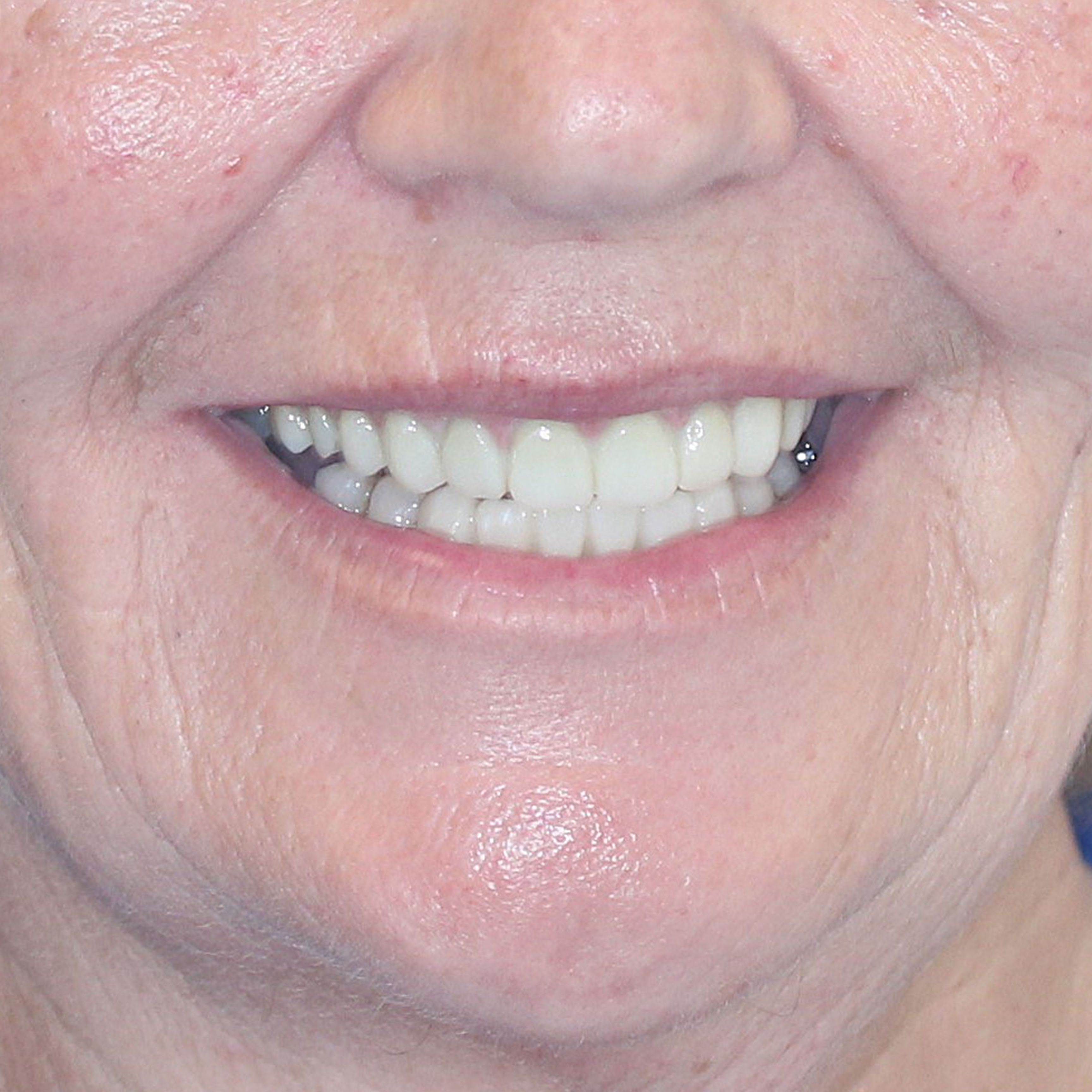 Porcelain Veneers