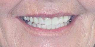 Porcelain Veneers