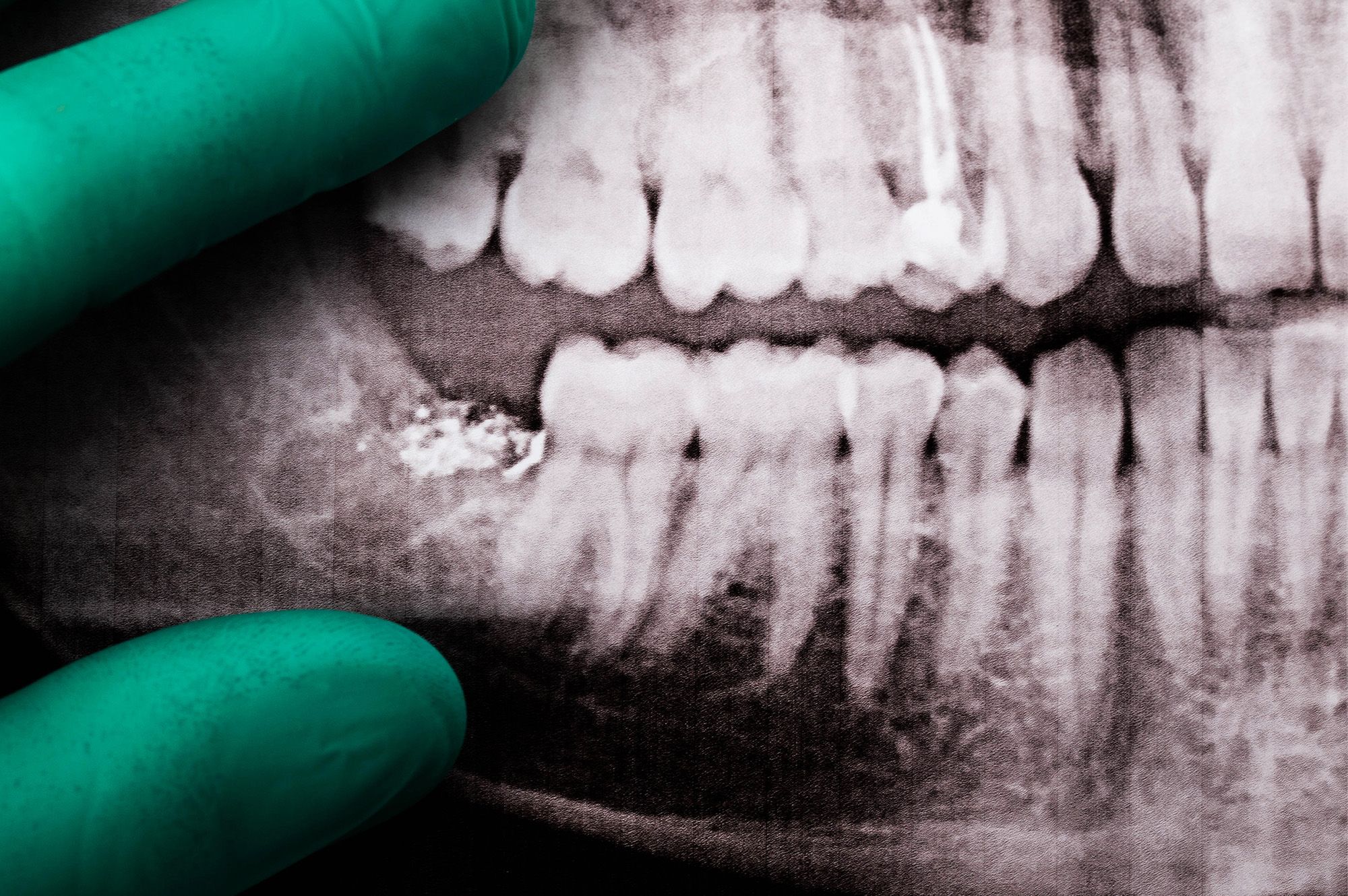 Is it Time for a Wisdom Teeth Evaluation?