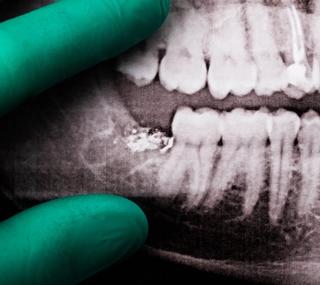 1. Initial Consultation & X-Rays: