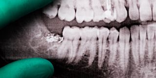 Is it Time for a Wisdom Teeth Evaluation?