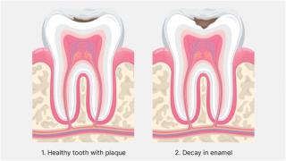 First stages of tooth decay