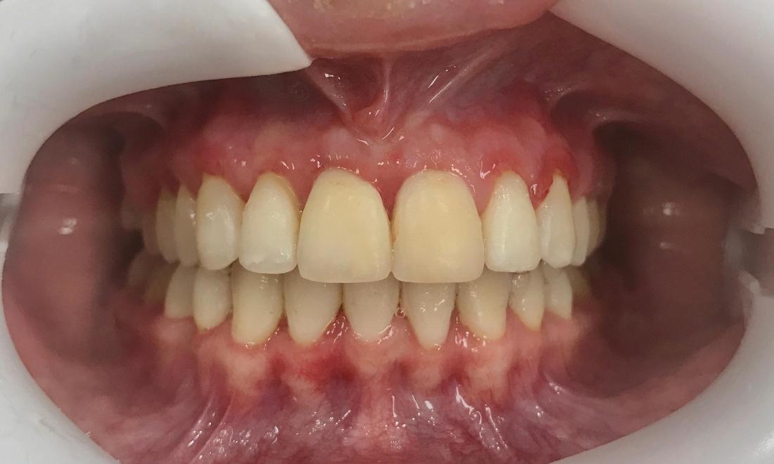 Braces and Invisalign - After