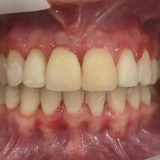 Braces and Invisalign - After