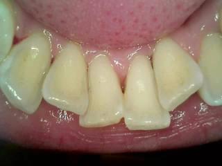 Dental Cleaning 1 - After