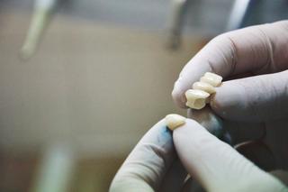 Dental Bridge