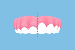 Benefits of Gum Lift Treatment