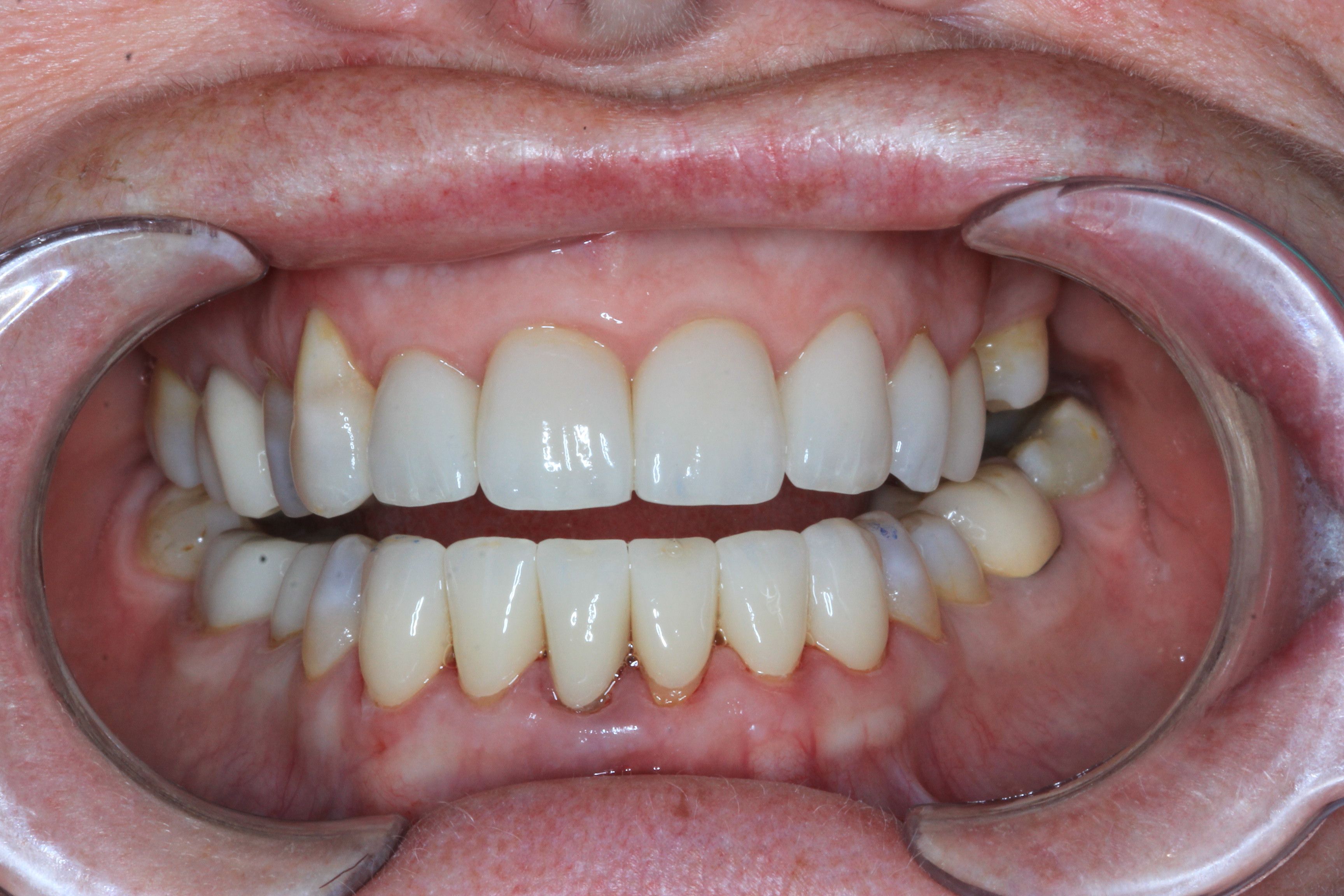 after dental crown