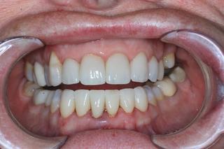 after dental crown
