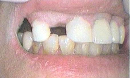 Crowns and Bridges - Before