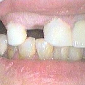 Crowns and Bridges - Before