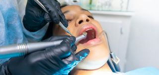 Dental Crowns