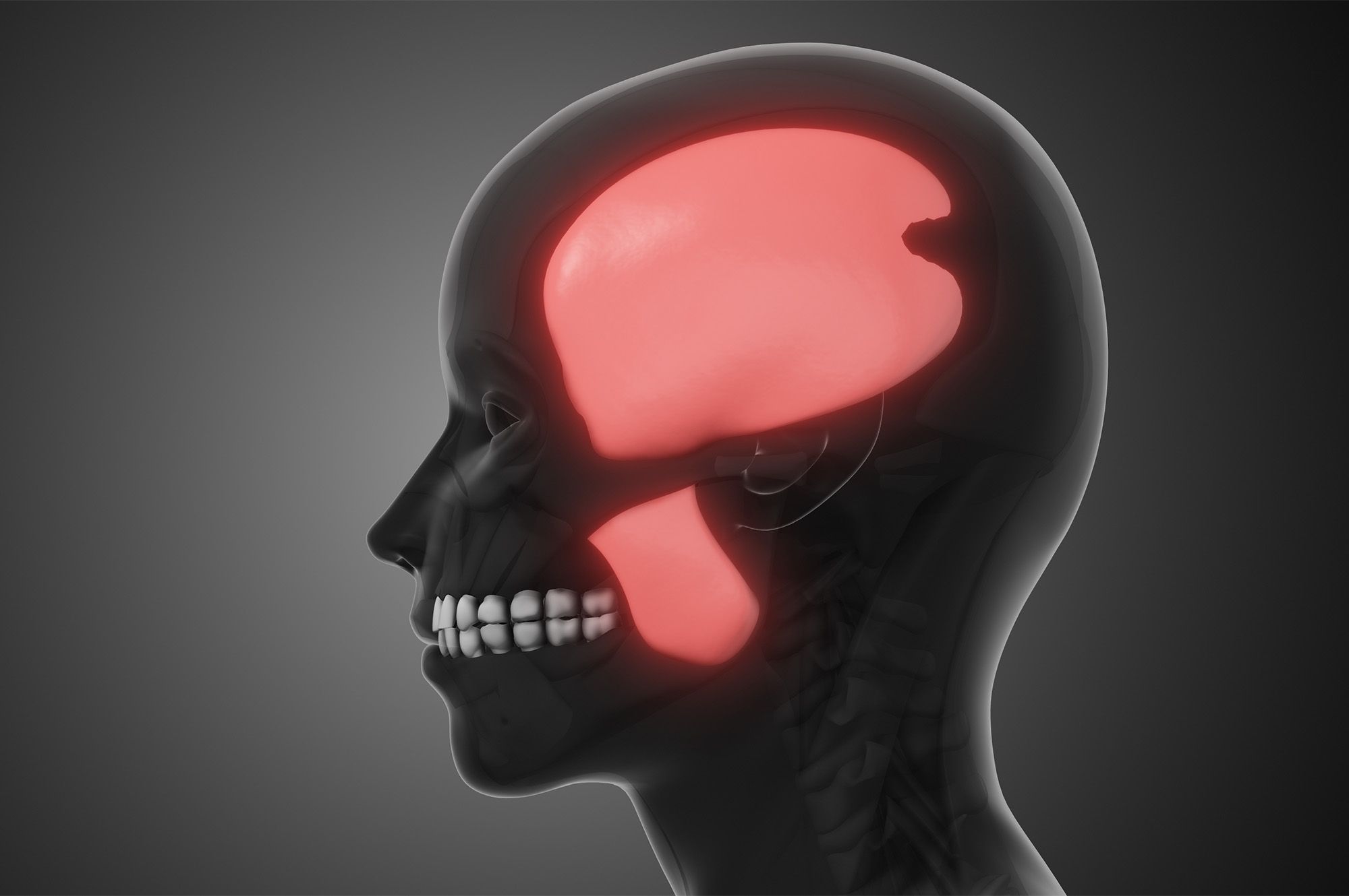 Consequences of Untreated Teeth Grinding