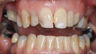 Veneers 1 - Before