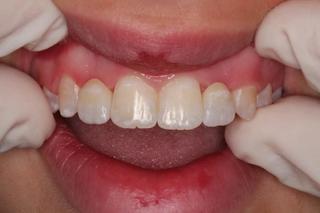 Dental Crown 1 - After