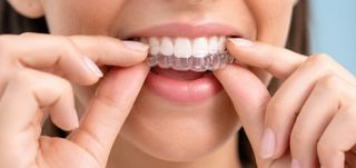 Invisalign