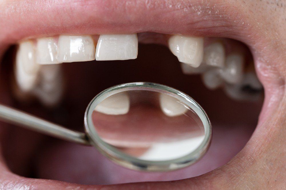 Missing Teeth
