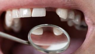 Missing Teeth
