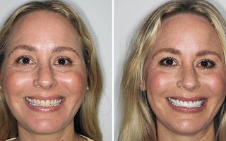 Dental veneers - before and after