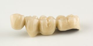 All-Porcelain Crowns