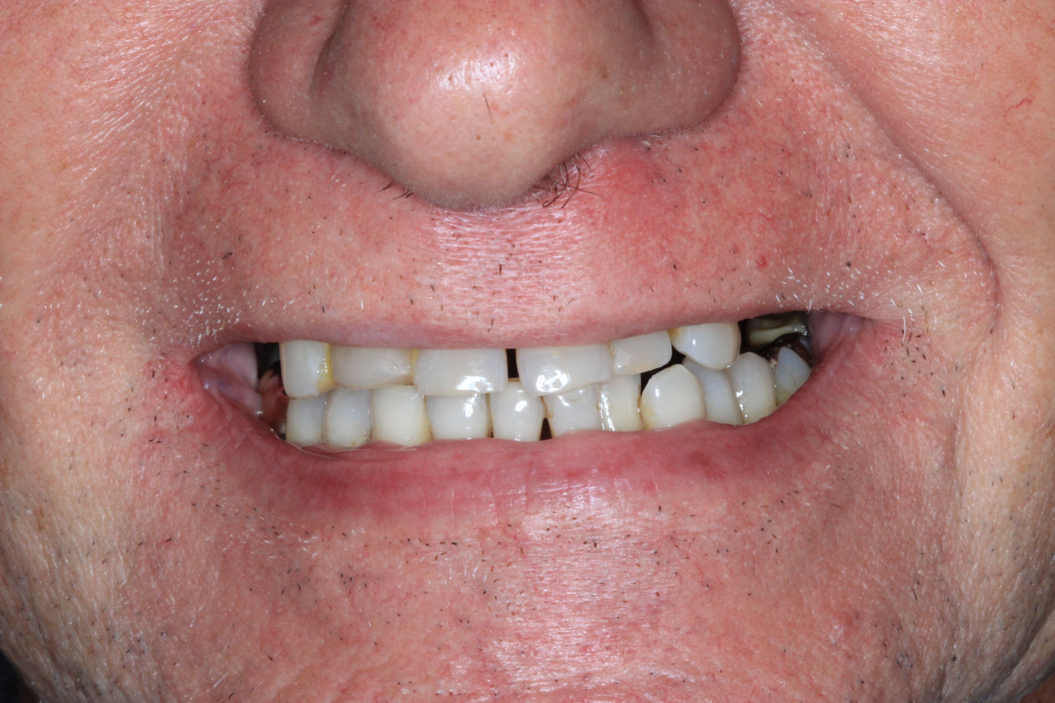 before implant retained denture