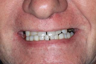 before implant retained denture