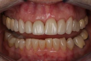 After image of a Crown and Bridge on a patient.