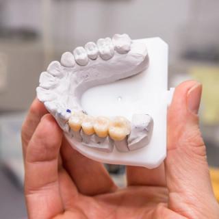 A dental bridge on a model of teeth.