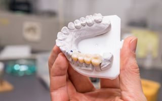 Bridging smiles with a Dental Bridge