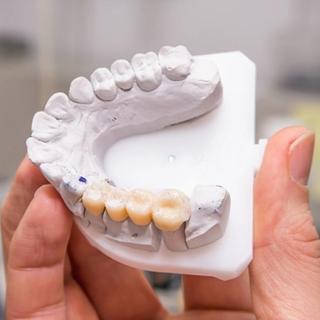 What Is a Dental Bridge?