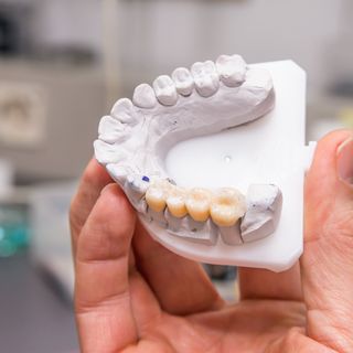 Image of a traditional bridge on a plaster jaw.