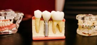 Restore your smile with Dental Implants