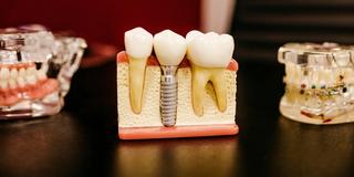 Loose Dental Implants: All You Need To Know - Hero