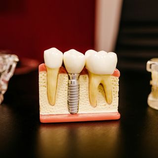 Dental Implants in Ranford Road Dental Centre.