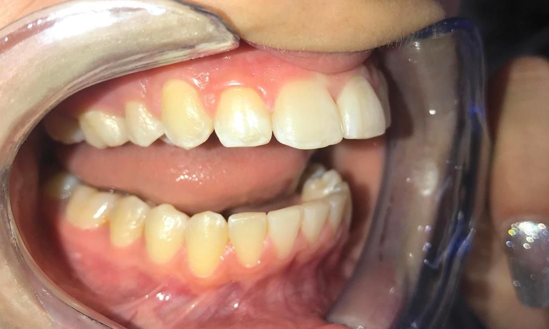 Braces and Invisalign - After - Left Side