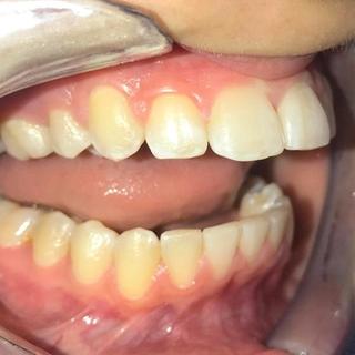 Braces and Invisalign - After - Left Side