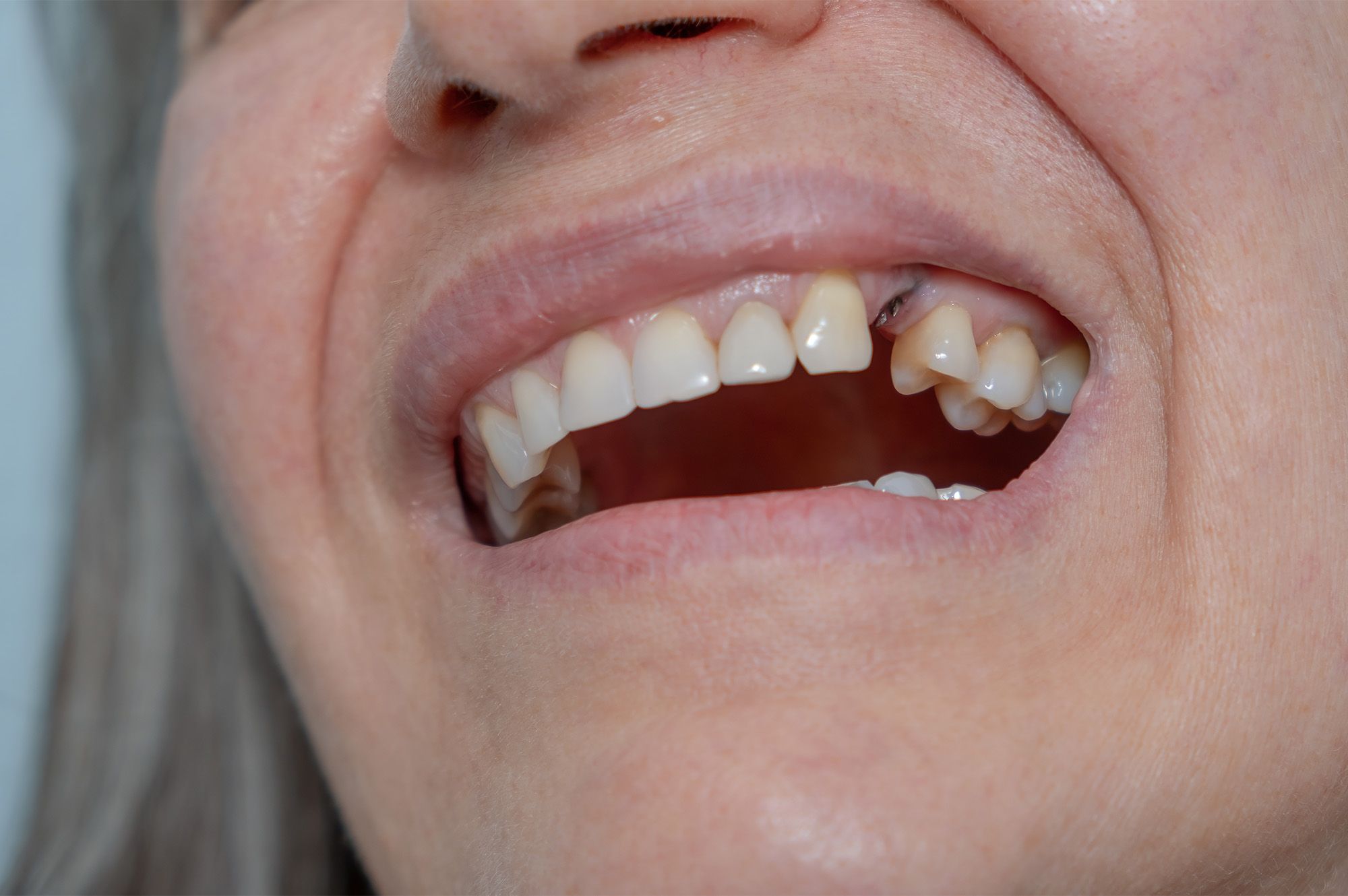 What Is a Dental Implant?