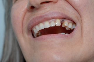 Dental Restorations