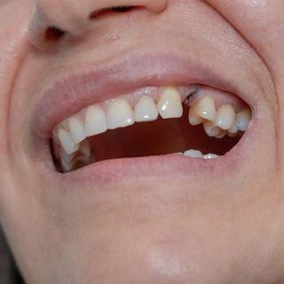 What Is a Dental Implant?