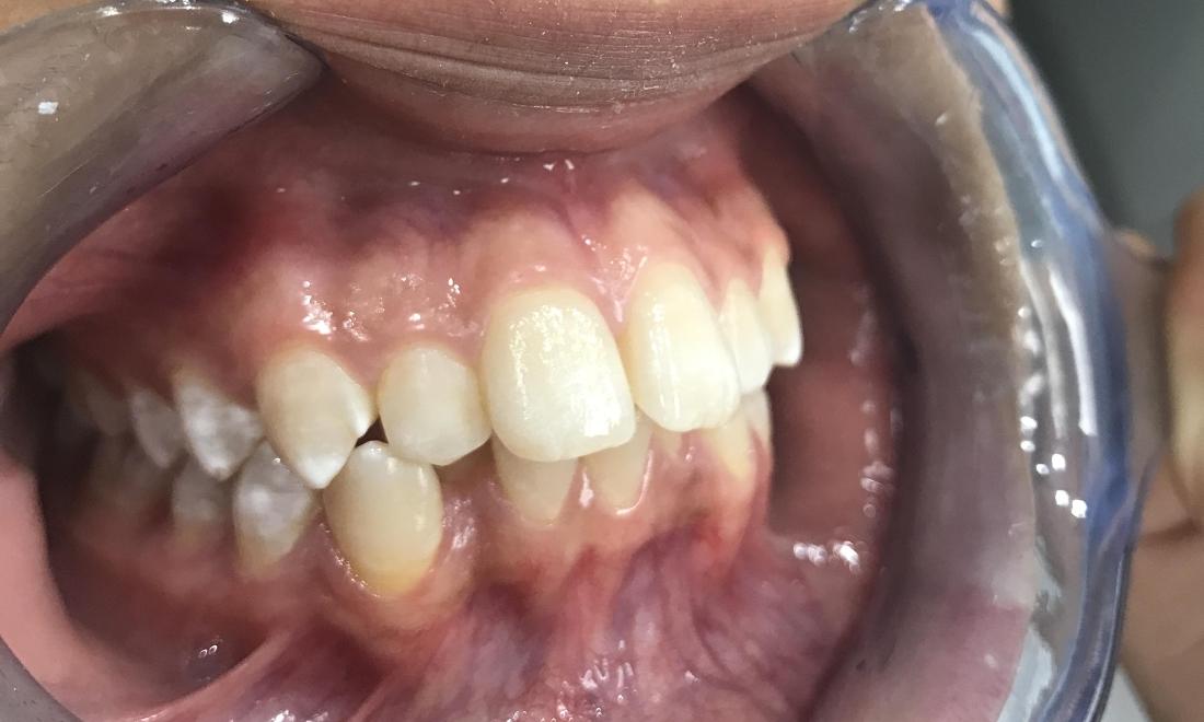 Braces and Invisalign - Before - Left Side