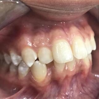 Braces and Invisalign - Before - Left Side