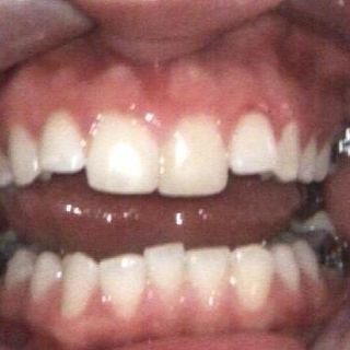 Braces and Invisalign - Before